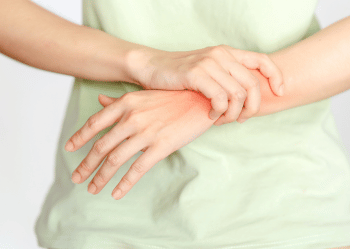 Arm in pain Common symptoms of a fracture including swelling bruising and deformity